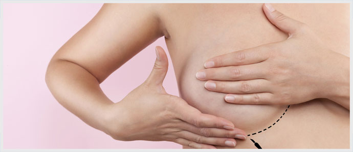 Woman with Breast Augmentation Job