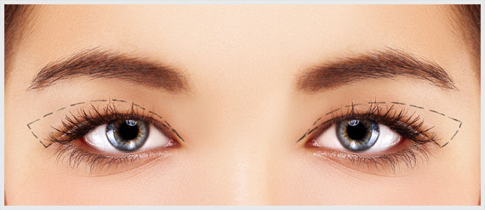 Eyelid Cosmetic Surgery for Woman