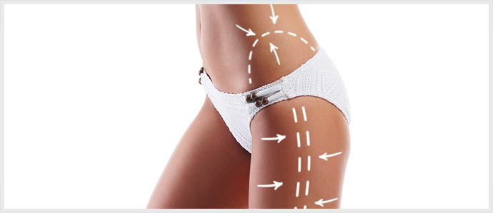 Liposuction Areas of Fat Reduction