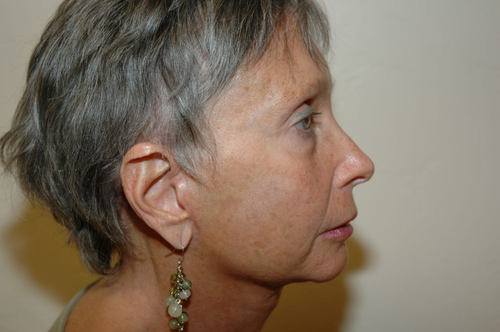 1-facelift-neck-lift-2