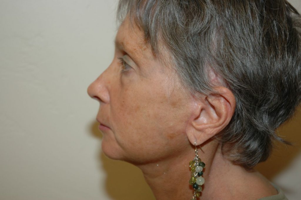 1-facelift-neck-lift-3