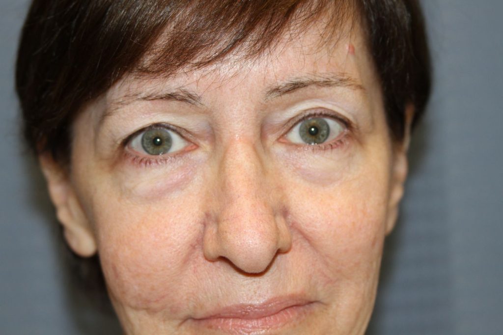 Eyelid Lift