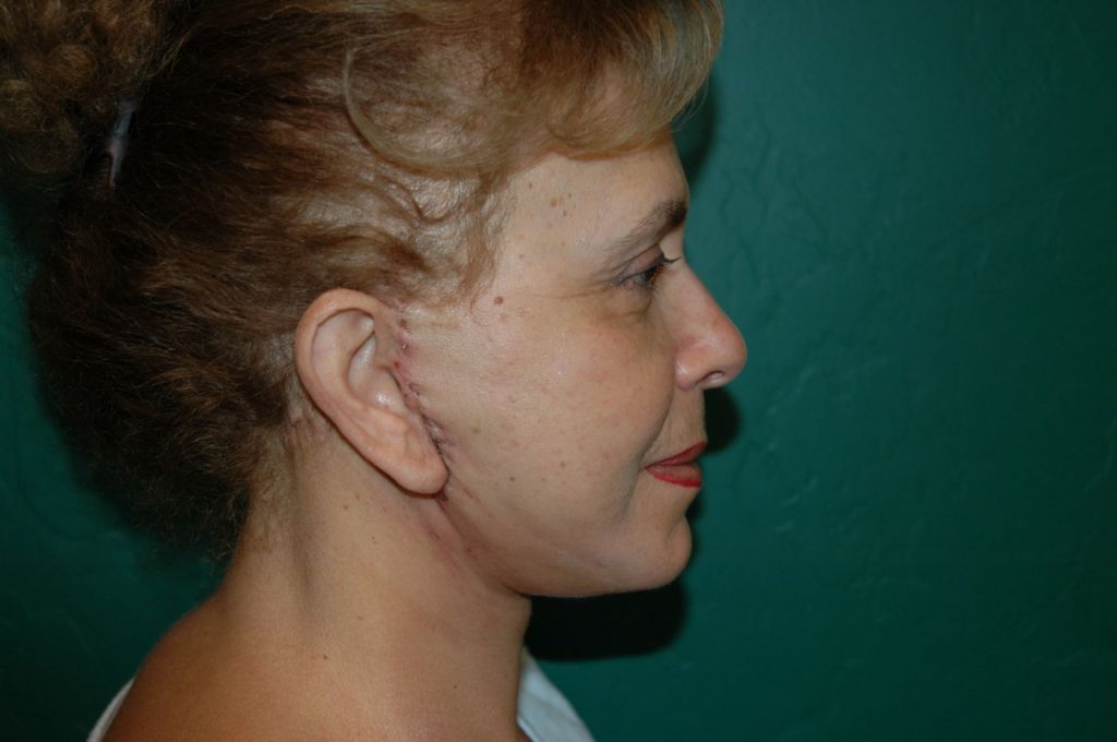 10-facelift-neck-lift-2