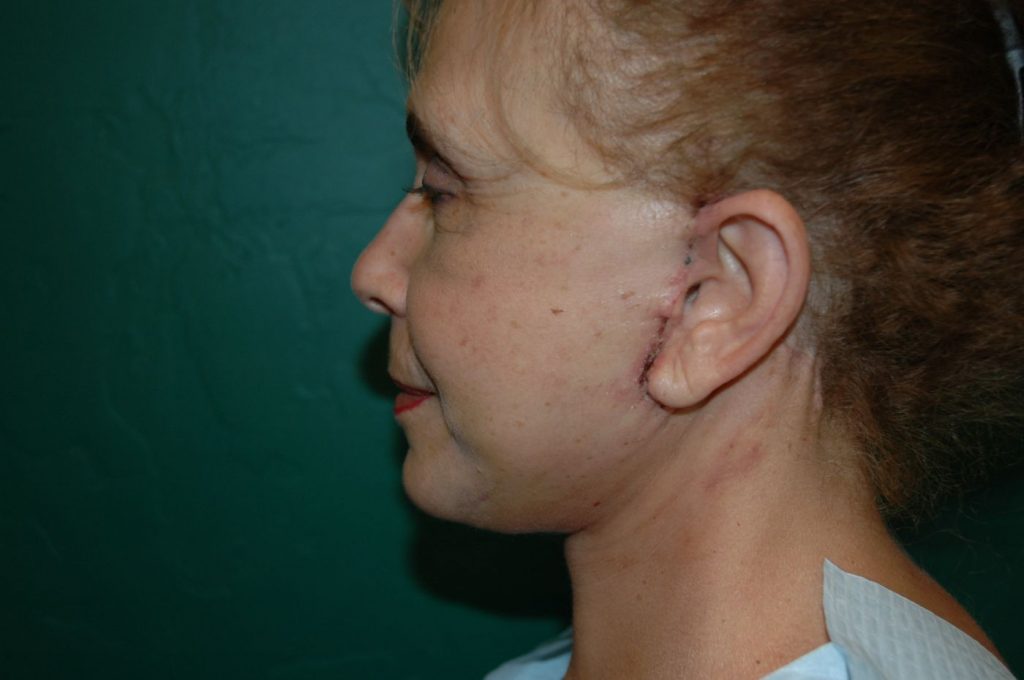 10-facelift-neck-lift-6