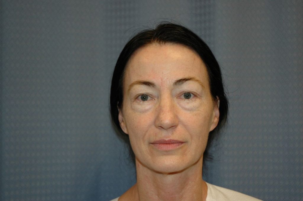 Eyelid Lift