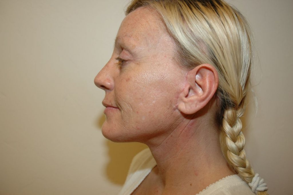 11-facelift-neck-lift-4