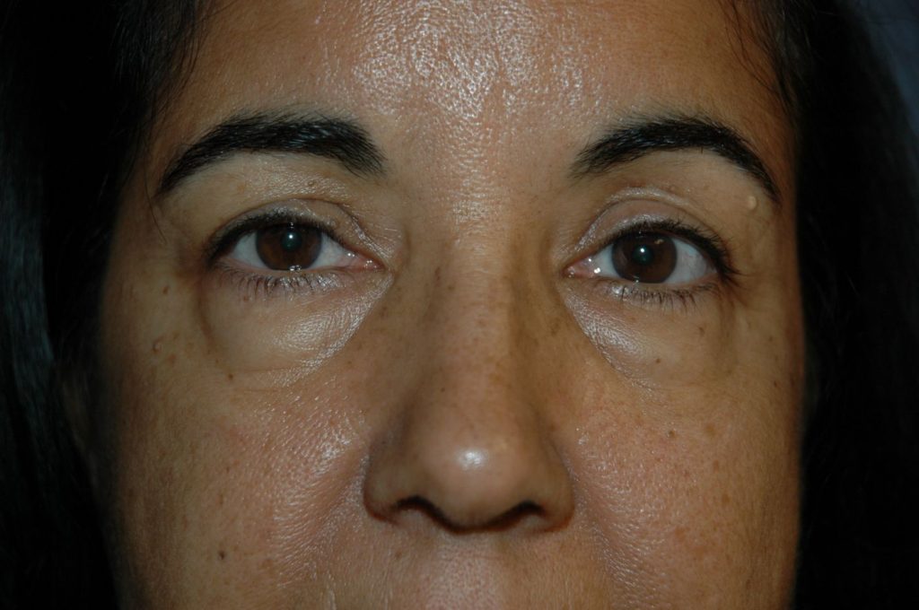 Eyelid Lift
