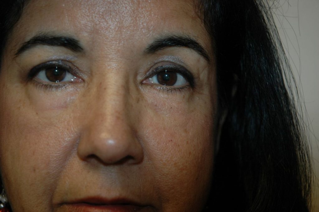 Eyelid Lift