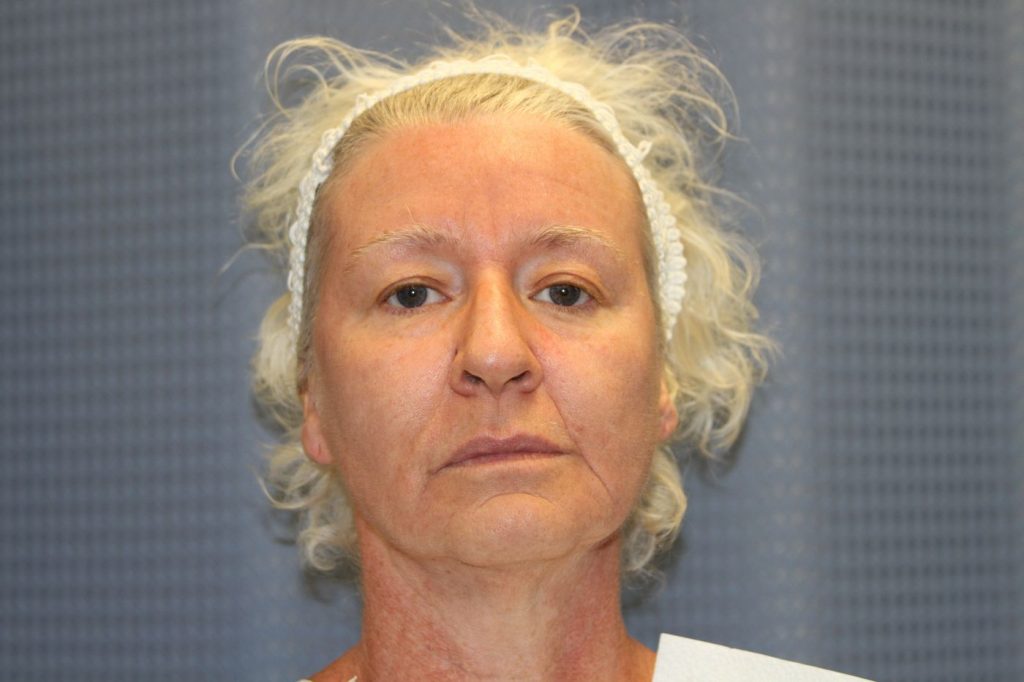 Facelift & Neck Lift