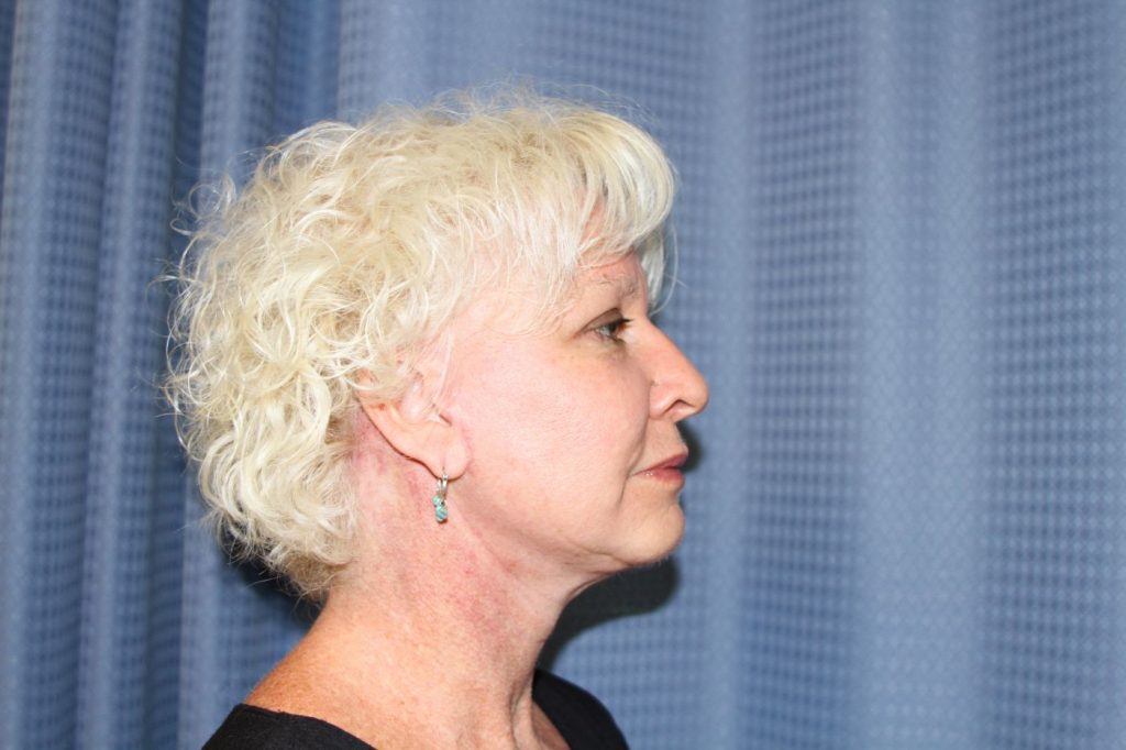 12-facelift-neck-lift-4