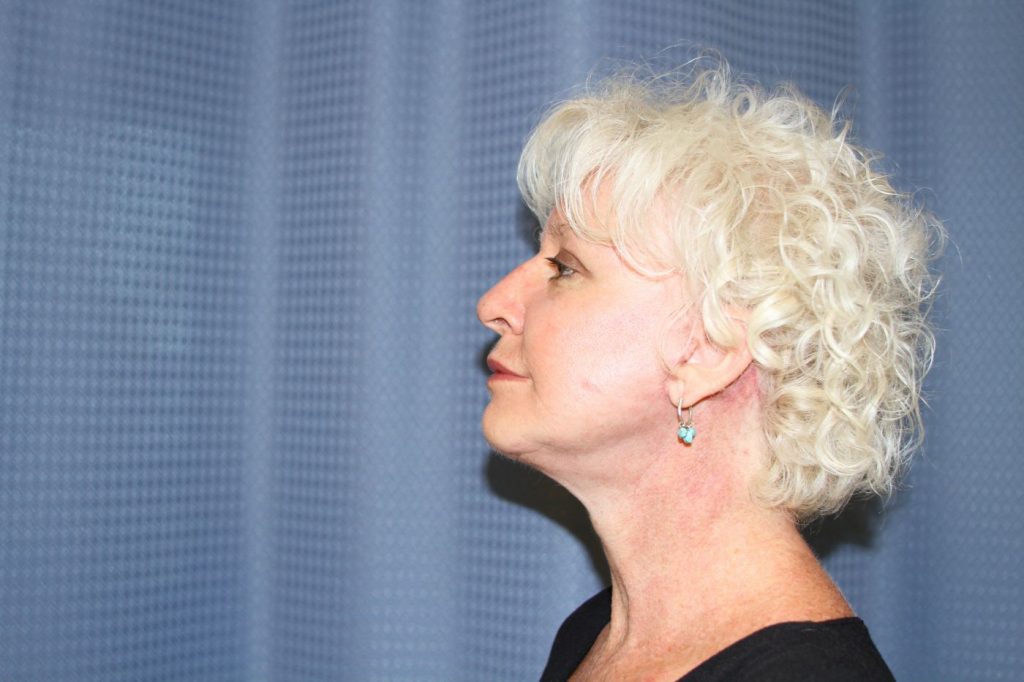12-facelift-neck-lift-6