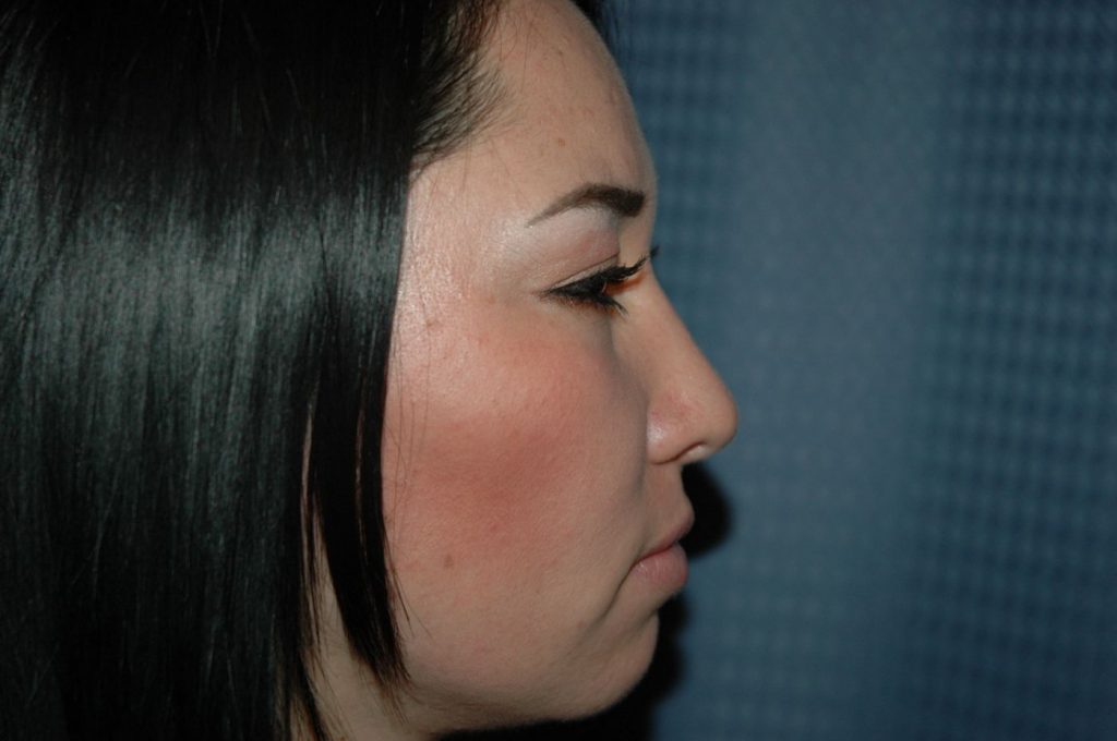 12-rhinoplasty-4