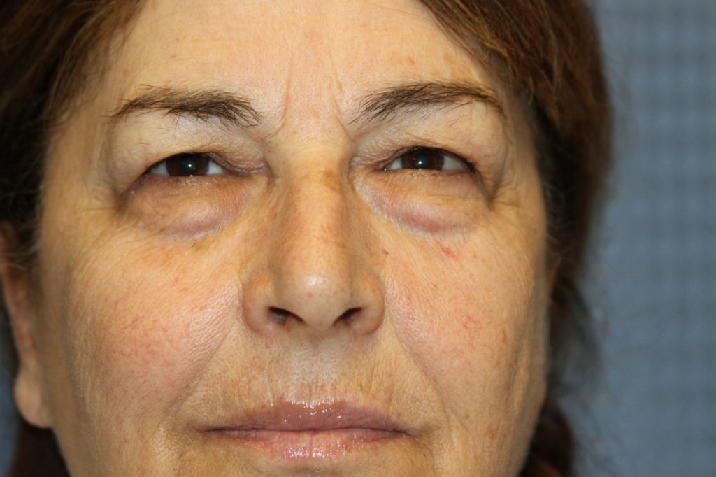 Eyelid Lift