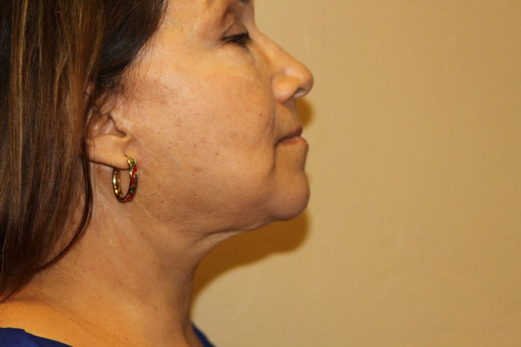 13-facelift-neck-lift-4