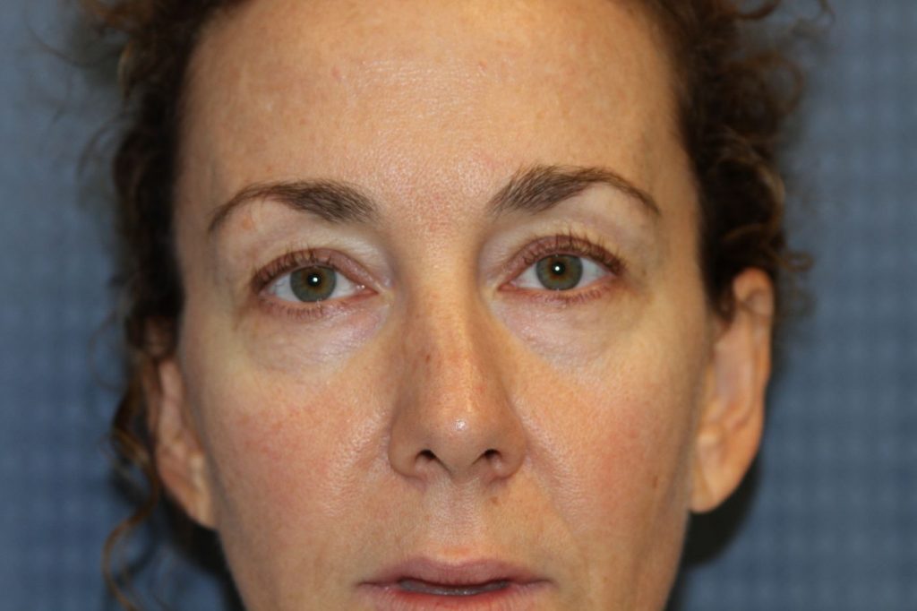 Eyelid Lift