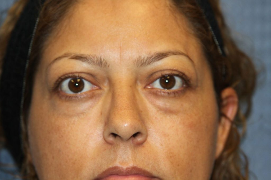 Eyelid Lift