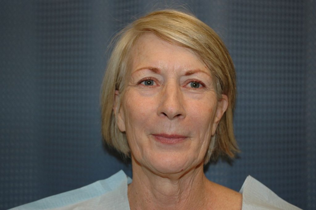 Neck Lift