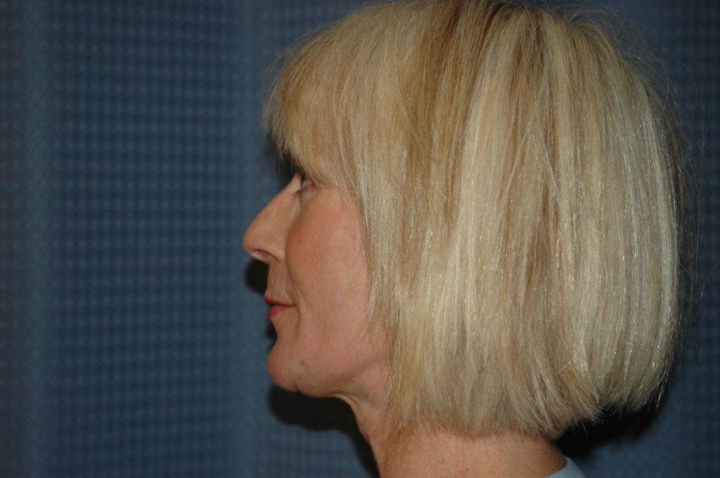 16-facelift-neck-lift-2