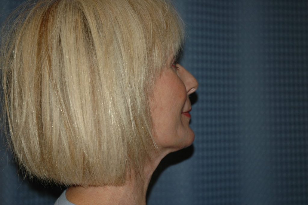 16-facelift-neck-lift-5