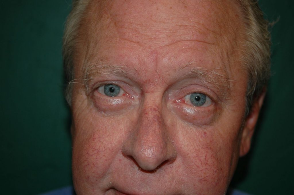 Eyelid Lift