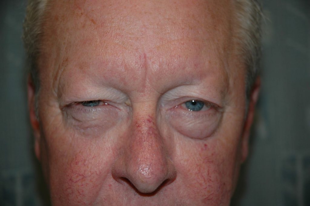Eyelid Lift
