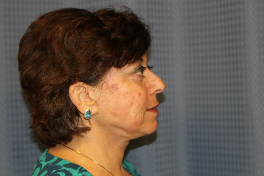 17-facelift-neck-lift-4