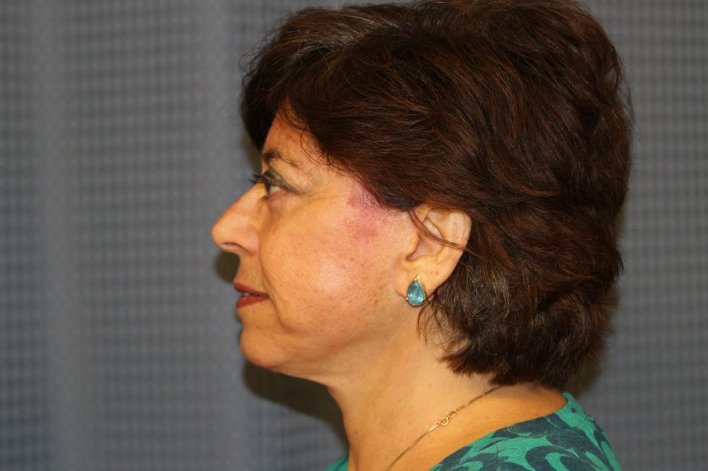 17-facelift-neck-lift-6
