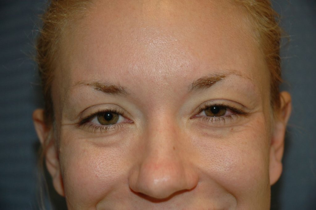 Eyelid Lift