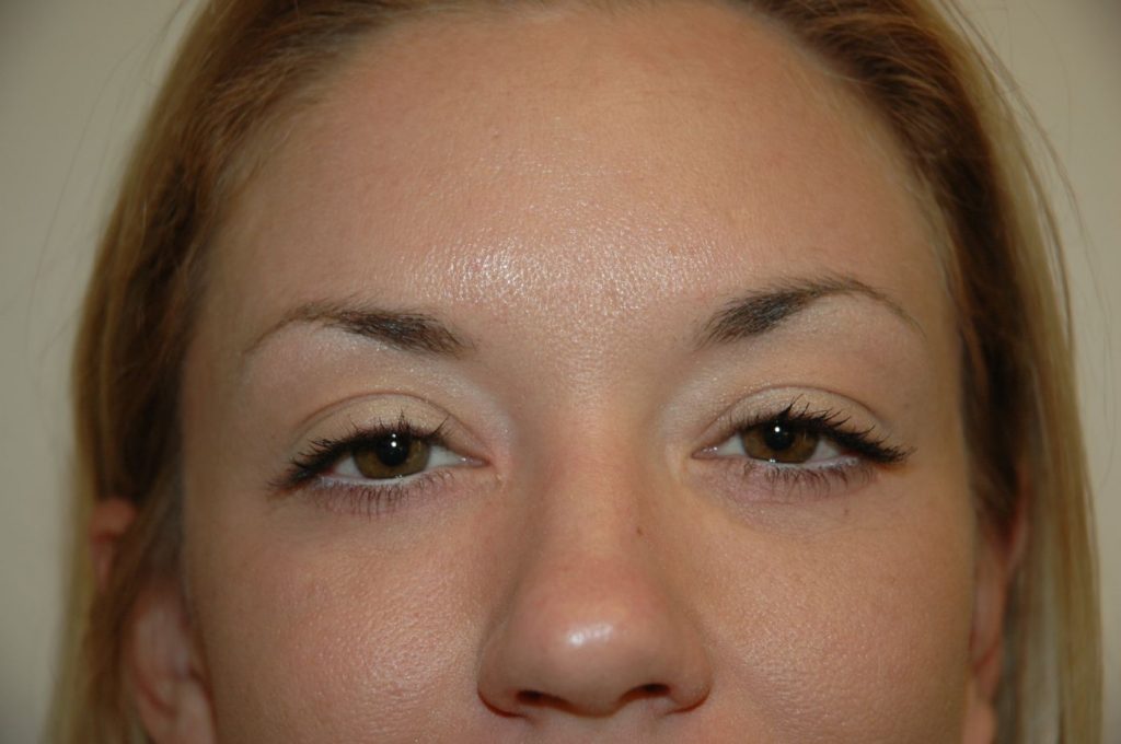 Eyelid Lift