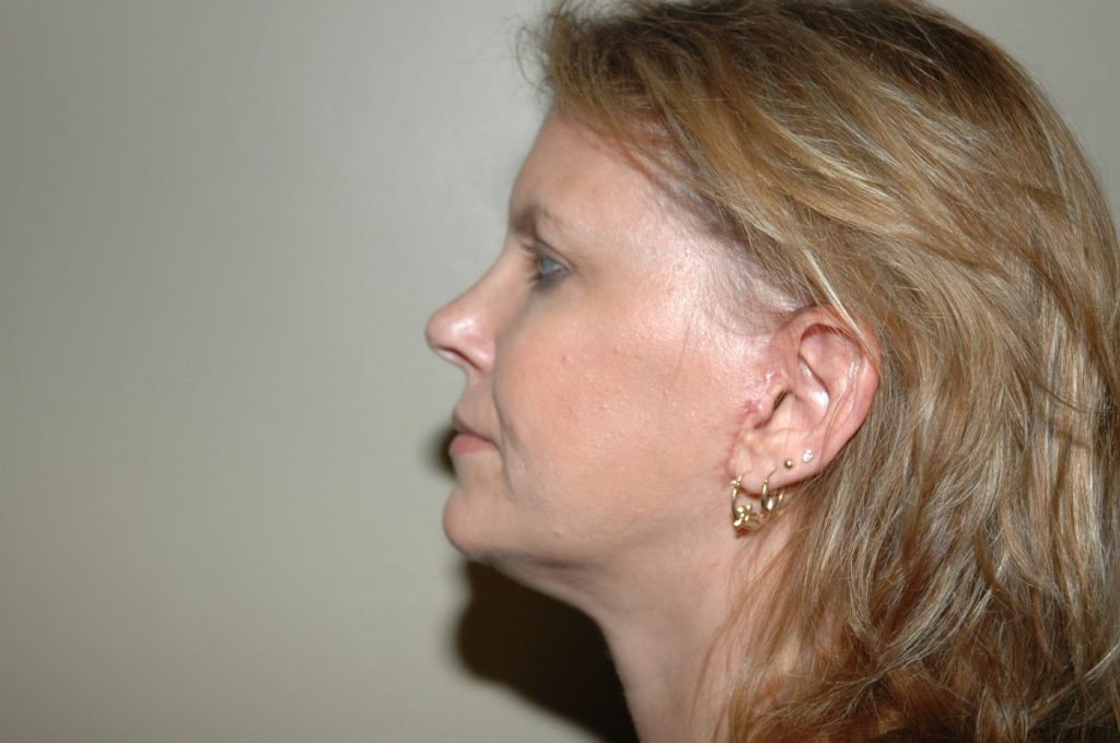 18-facelift-neck-lift-5