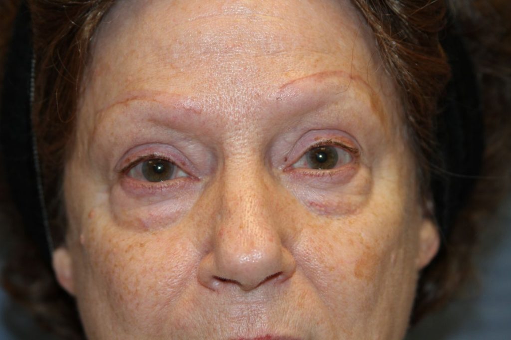Eyelid Lift