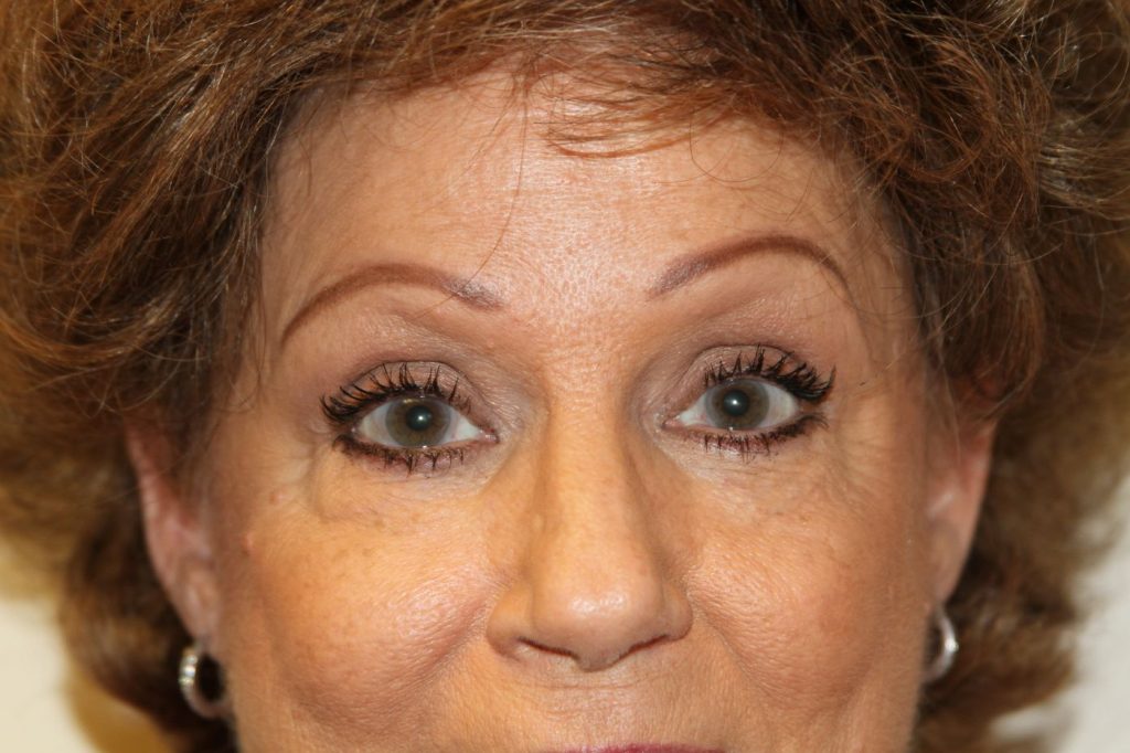 Eyelid Lift
