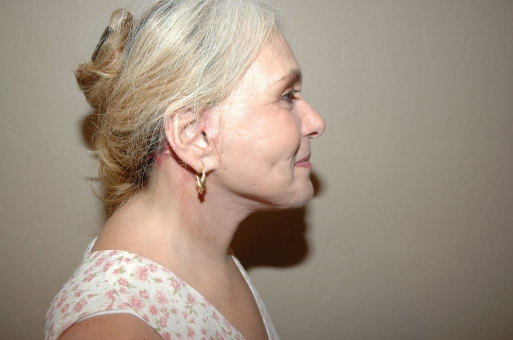 19-facelift-neck-lift-2