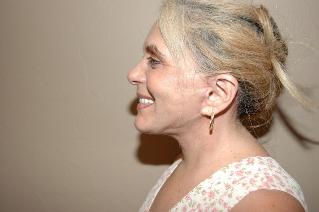 19-facelift-neck-lift-6