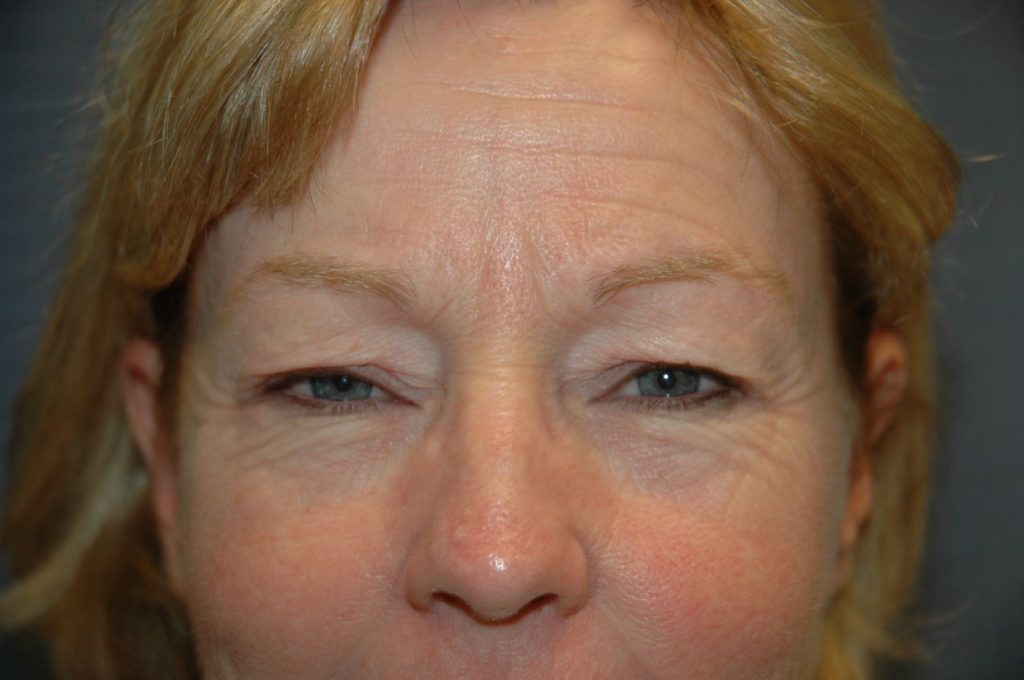 Eyelid Lift