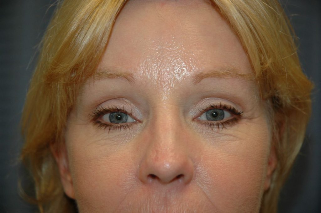 Eyelid Lift
