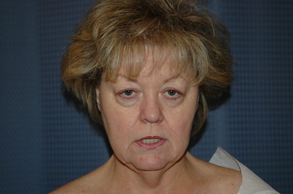 Eyelid Lift