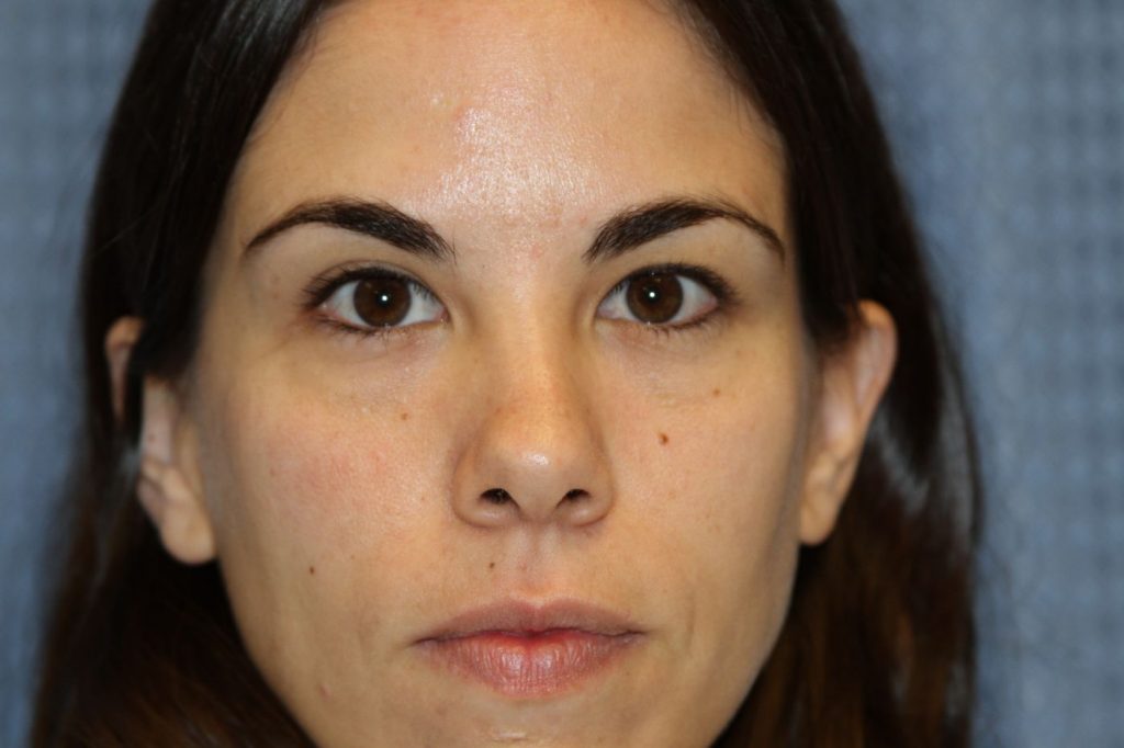 Eyelid Lift
