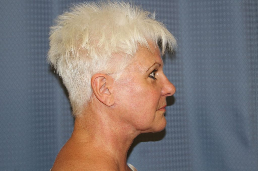 21-facelift-neck-lift-4