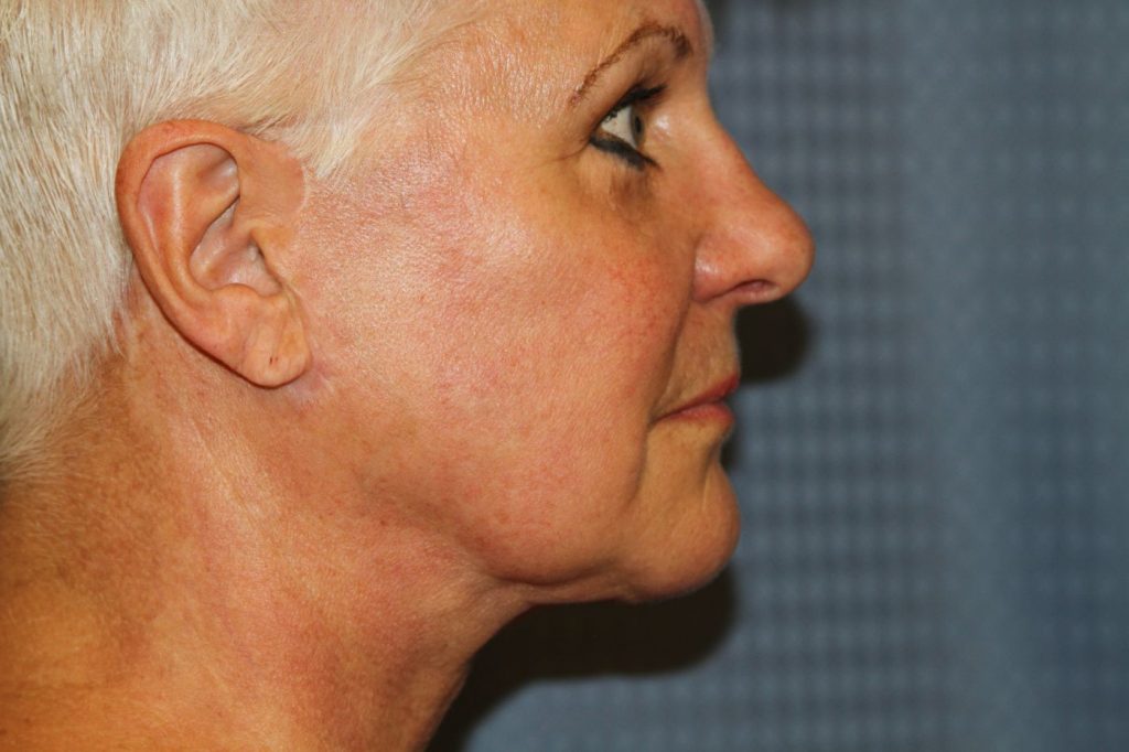 21-facelift-neck-lift-6