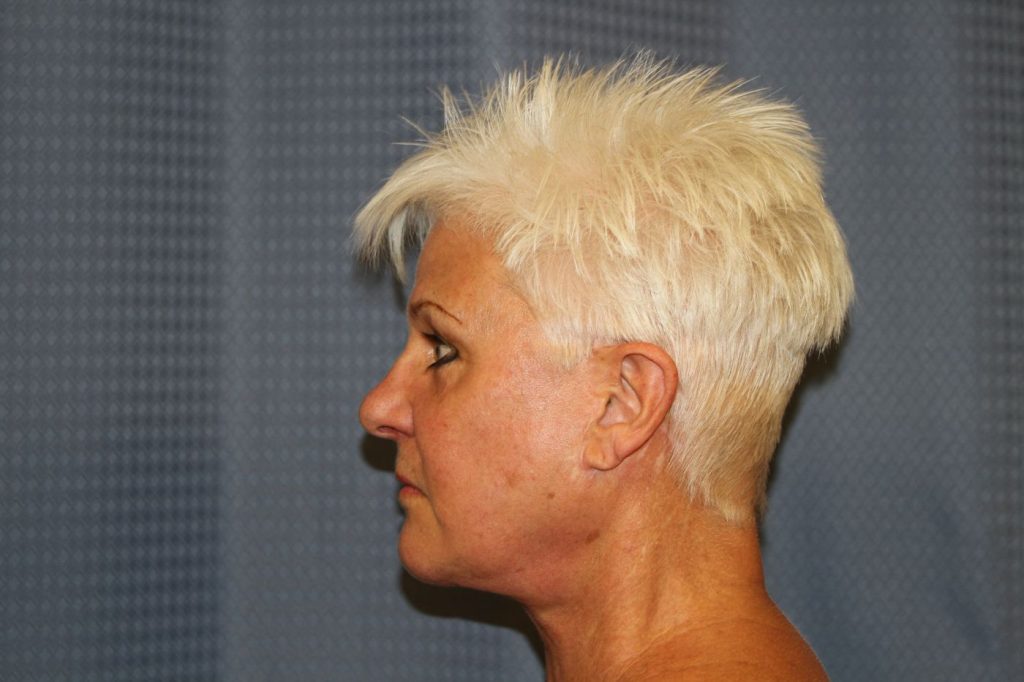 21-facelift-neck-lift-8