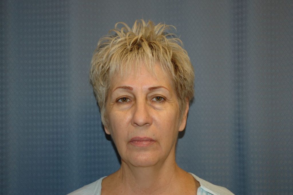 Facelift & Neck Lift