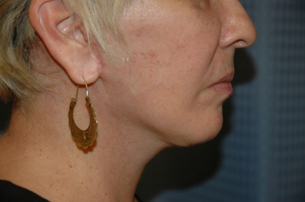 22-facelift-neck-lift-4