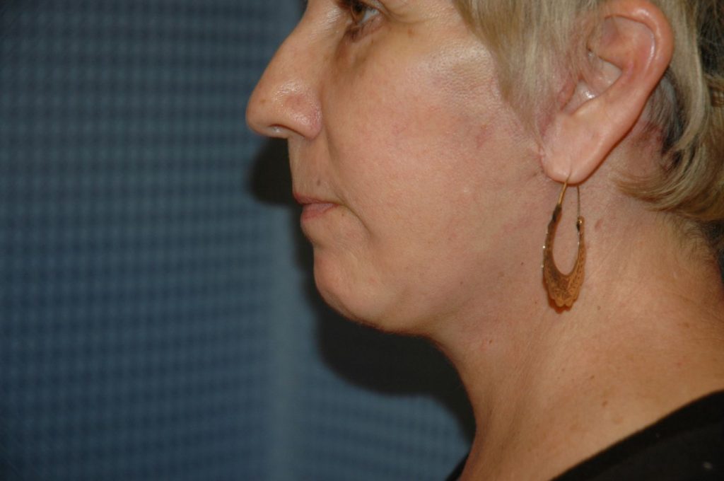 22-facelift-neck-lift-6