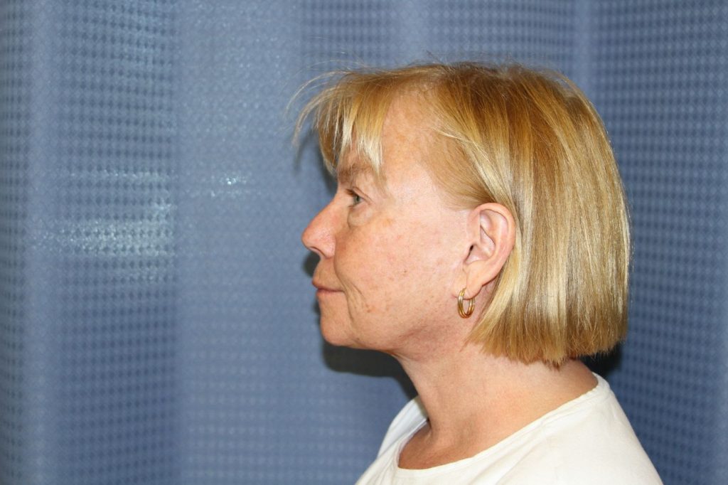 24-facelift-neck-lift-4