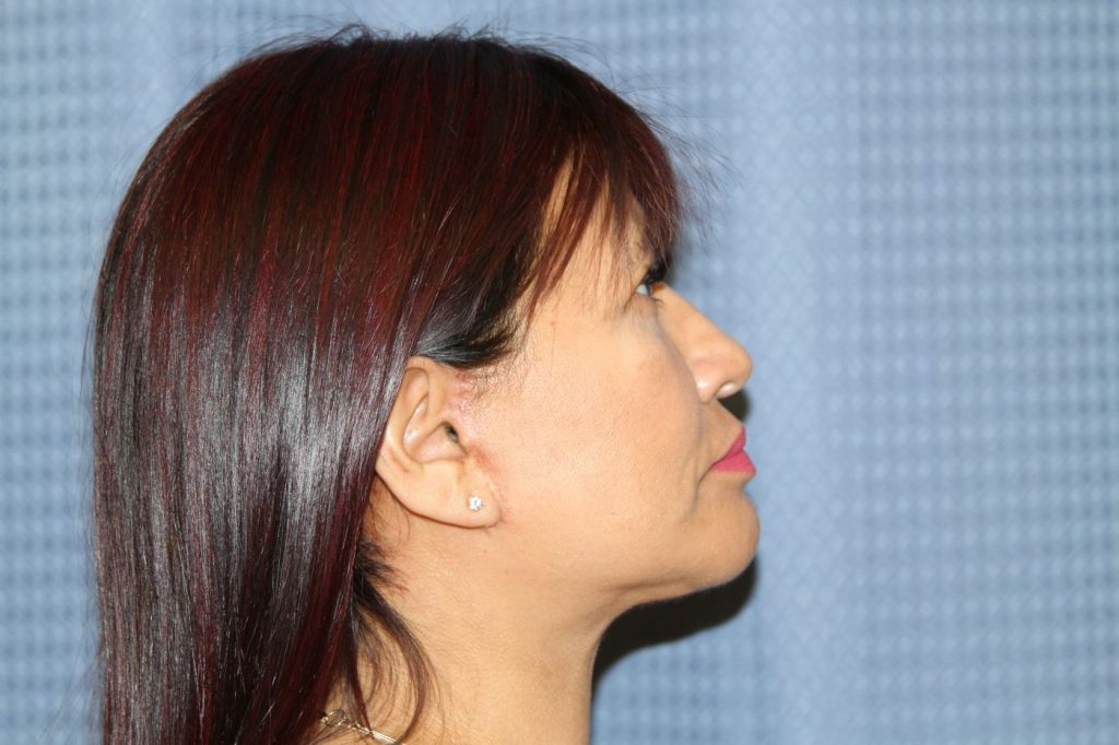 25-facelift-neck-lift-6