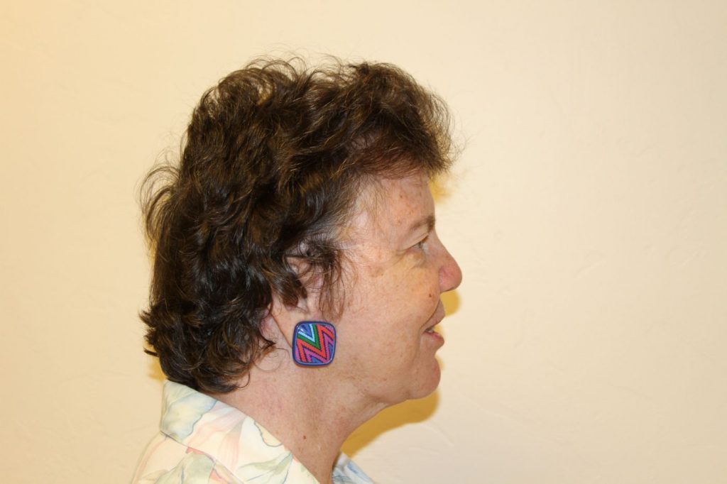 26-facelift-neck-lift-2