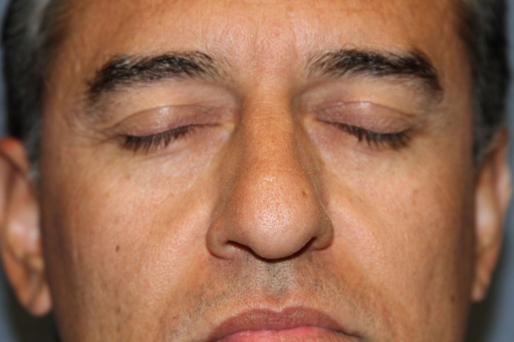 Eyelid Lift