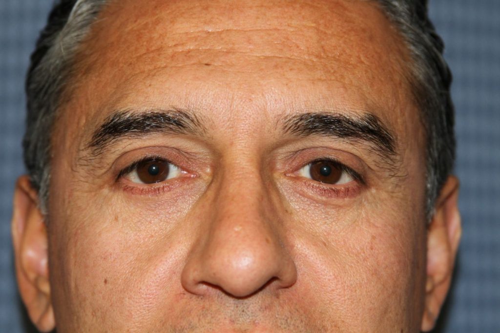 Eyelid Lift