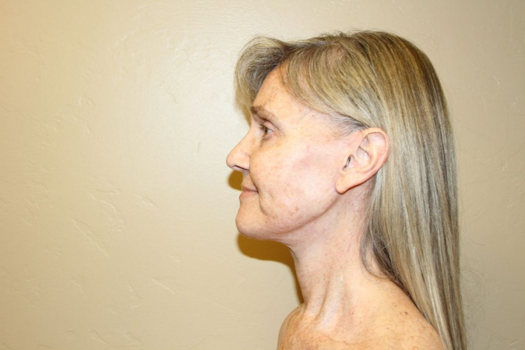 30-facelift-neck-lift-4